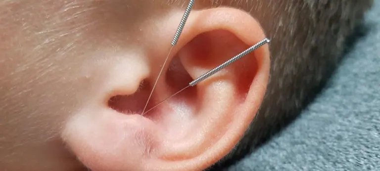 Acupuntura para Tinnitus