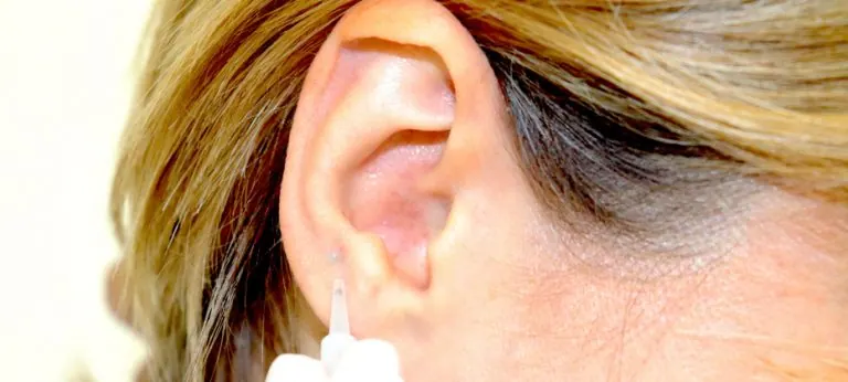 Auriculoterapia para Parkinson