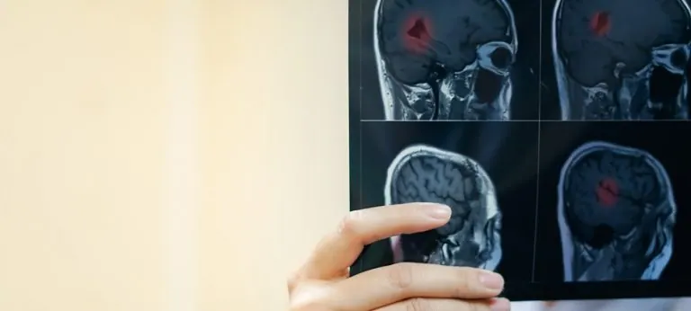 Cómo se diagnostica la esclerosis múltiple