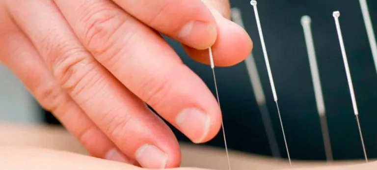 ¿Qué es la acupuntura?