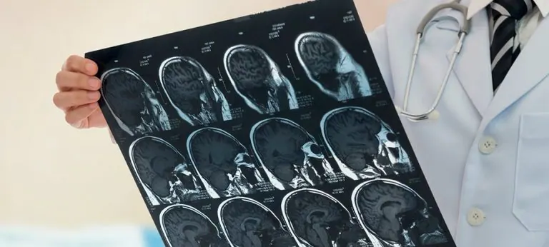 ¿Qué es la epilepsia?