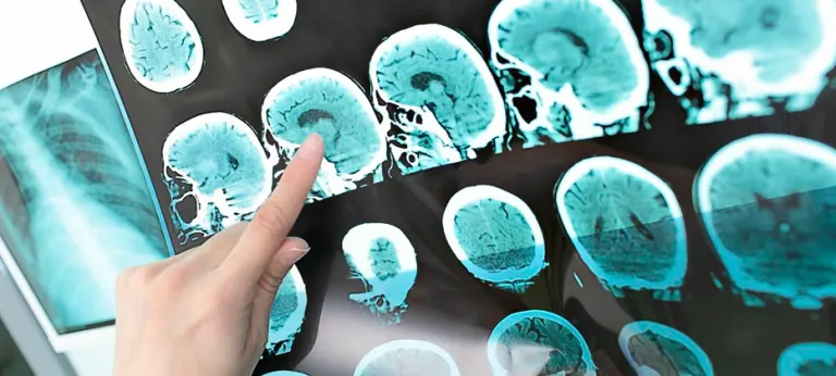 ¿Qué síntomas producen las enfermedades neurodegenerativas?
