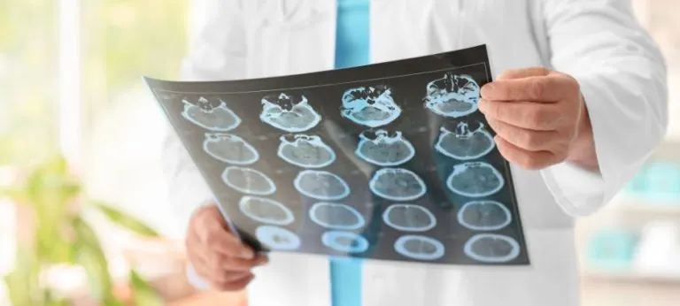 ¿Se puede tener Parkinson y Alzheimer a la vez?