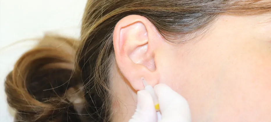 se puede tratar el Parkinson con acupuntura