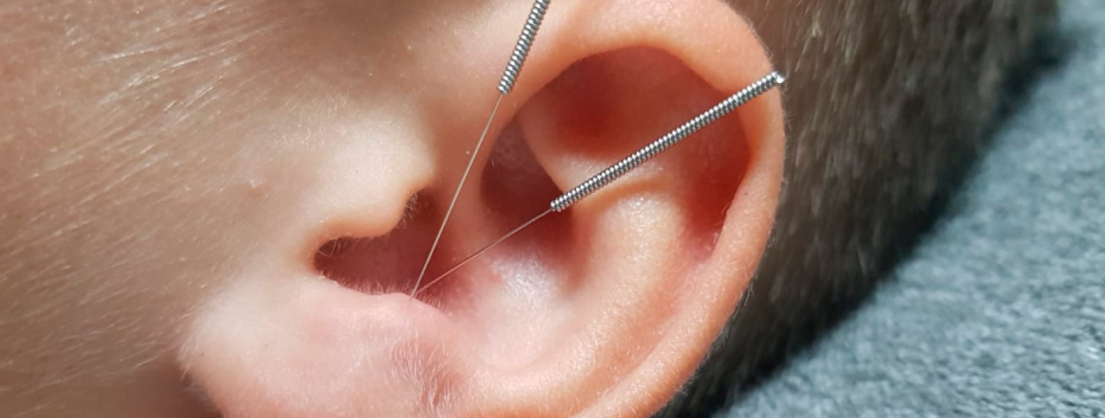 Acupuntura para Tinnitus Descubre sus beneficios aquí